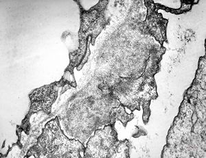 F,26y. | membranous glomerulopathy